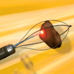 ESCAPE™ NITINOL STONE EXTRACTION BASKET - Image 2